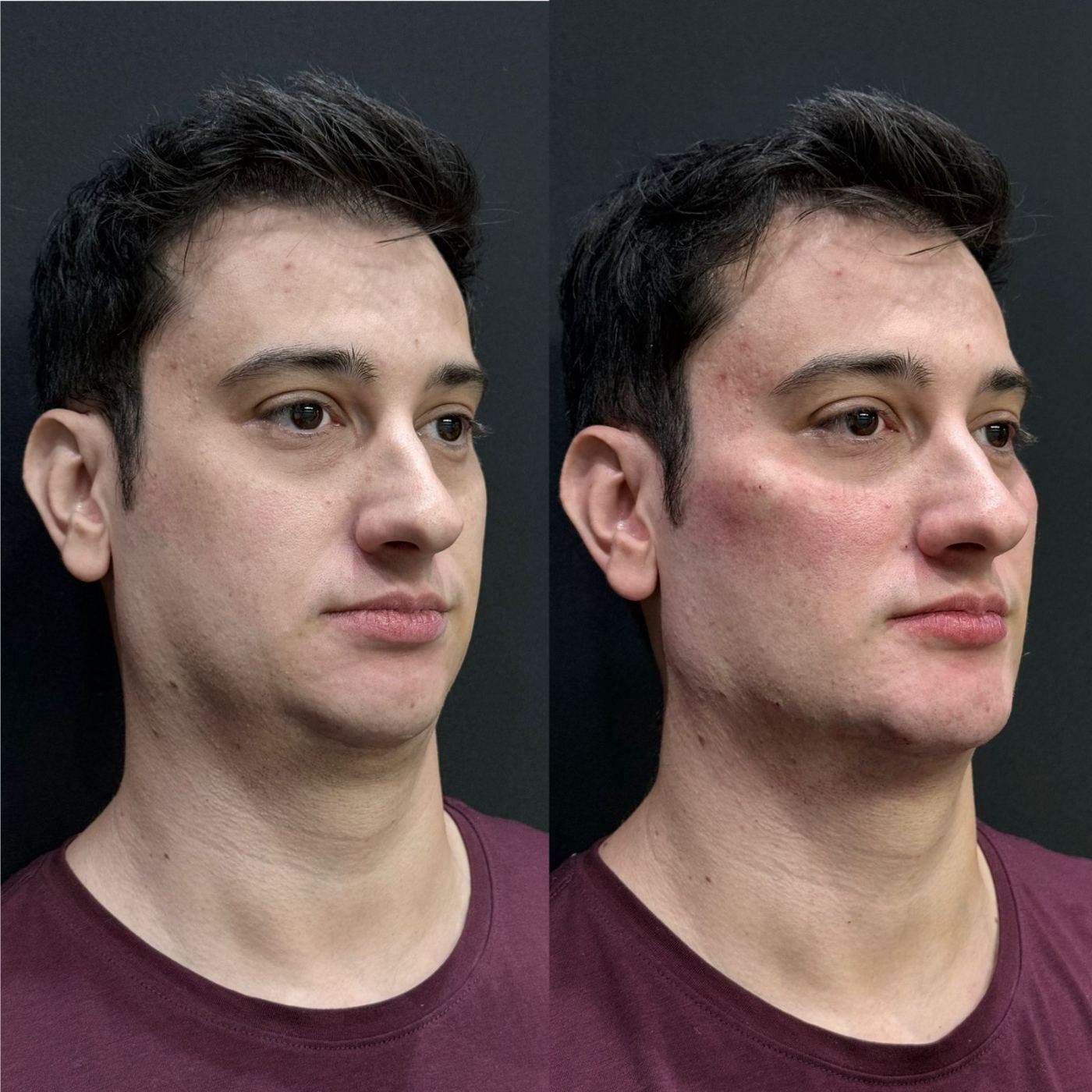 Antes e depois — Harmonização masculina