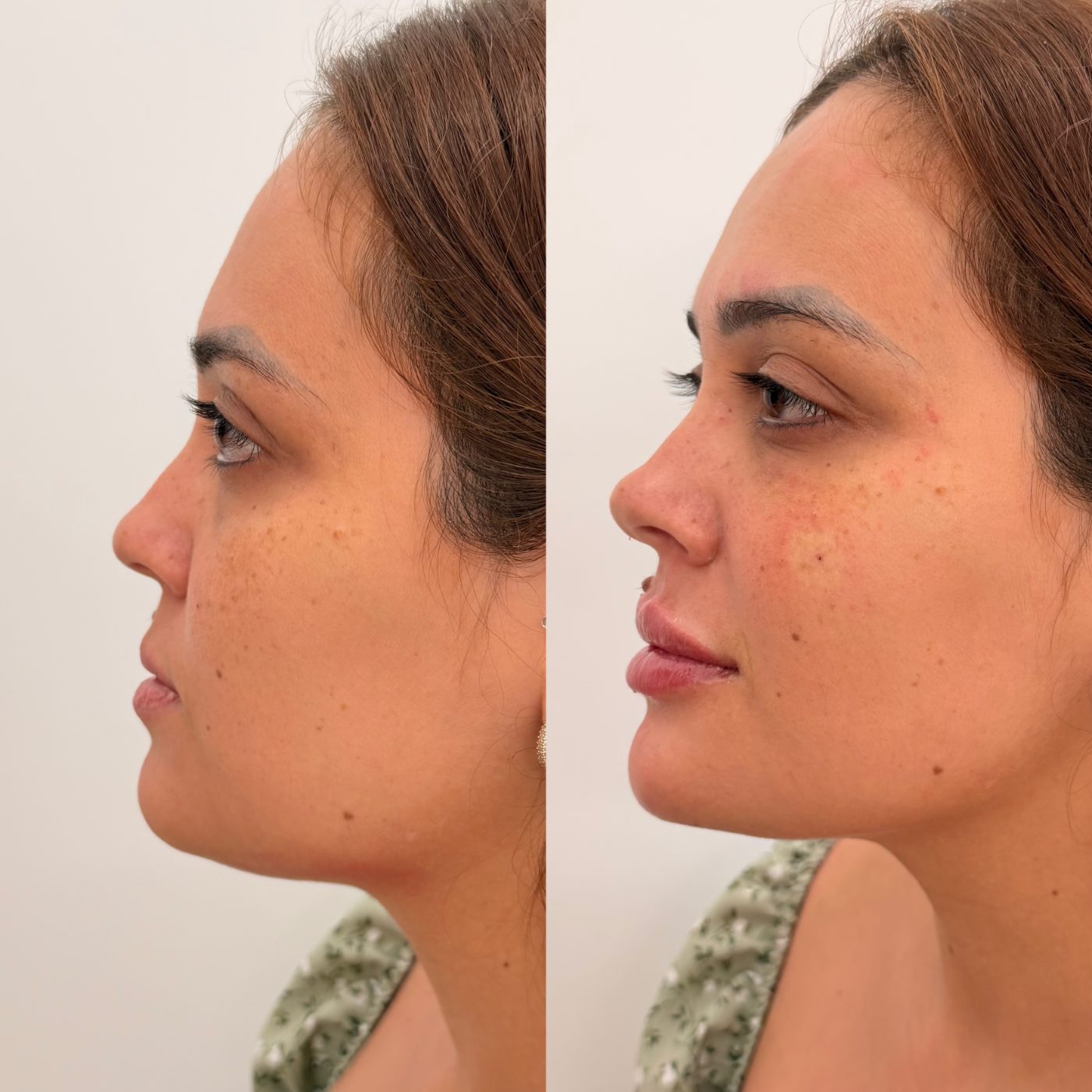 Antes e depois — Rejuvenescimento facial