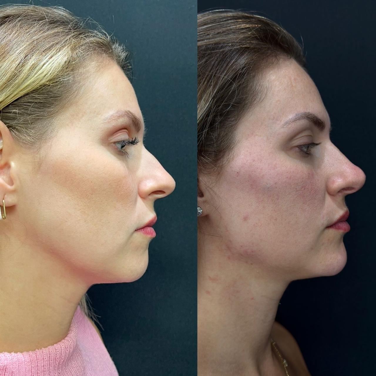 Antes e depois — Contorno mandibular