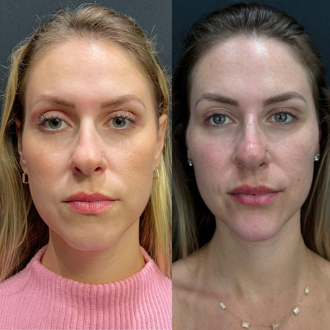 Antes e depois — Sustentação do terço médio