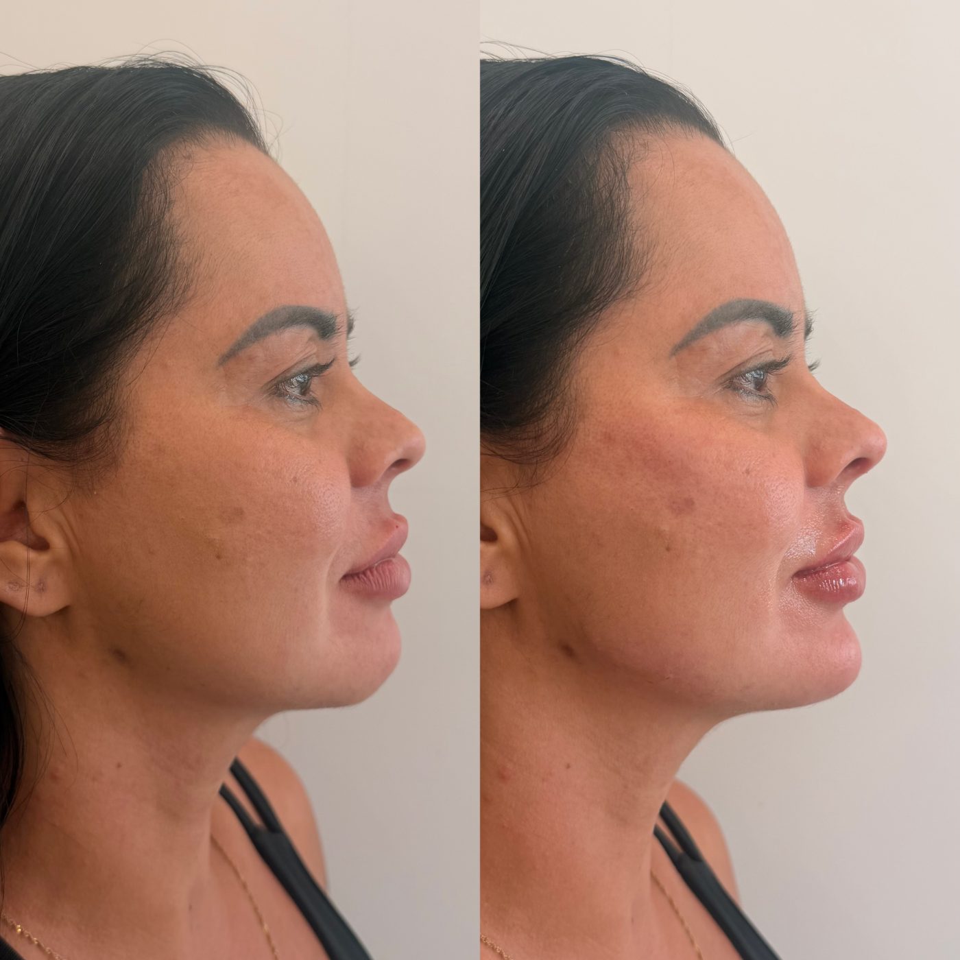 Antes e depois — Full Face completo