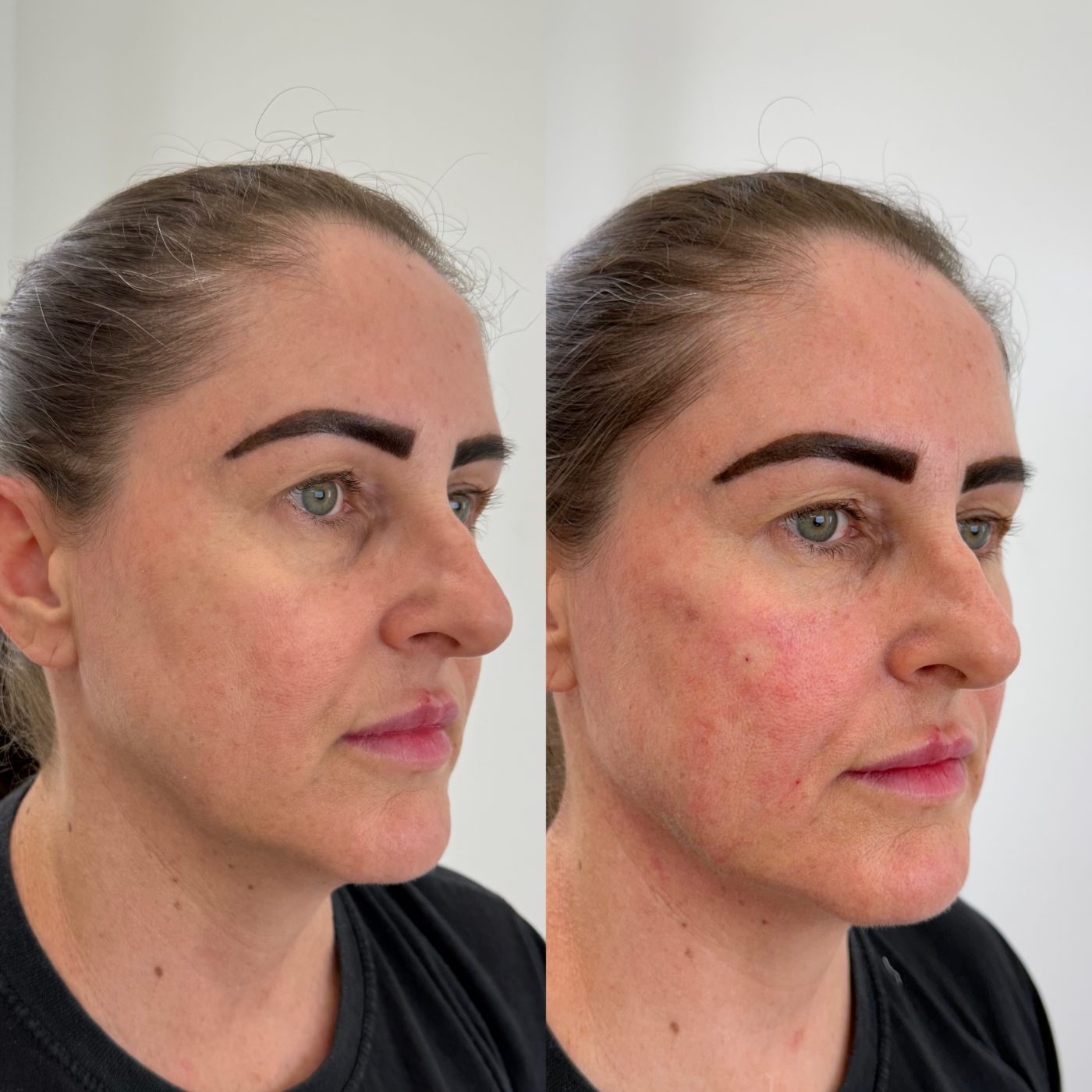 Antes e depois — Harmonização frontal